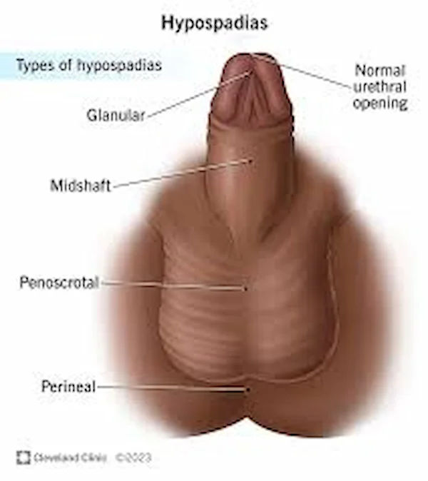 Understanding Subcoronal Hypospadias